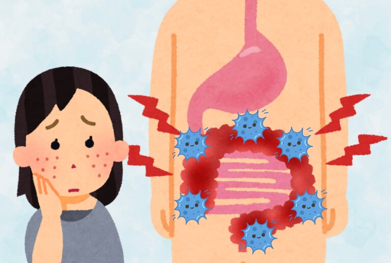 便秘になると肌が荒れる理由は？腸内環境の悪化がニキビの原因？ 