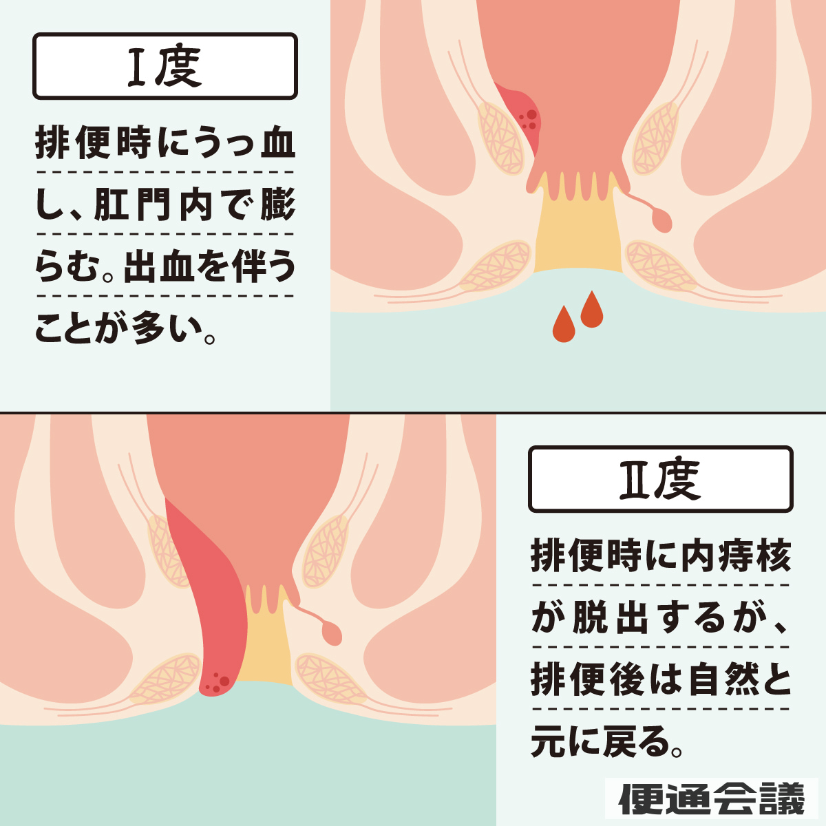 ゴリガ―の臨床病期分類1