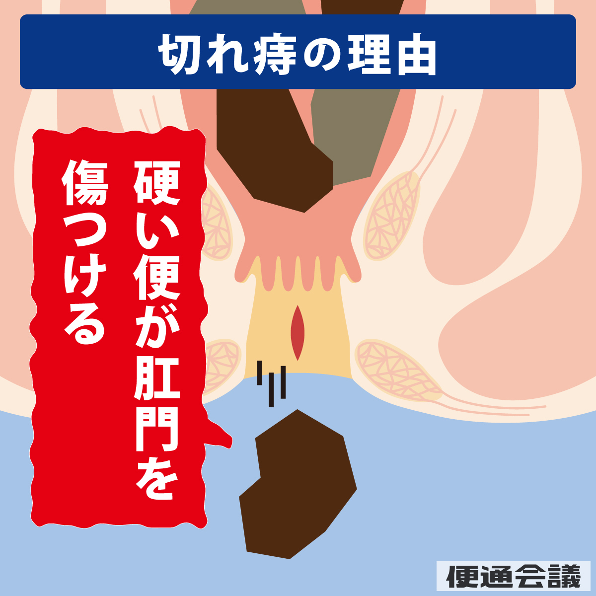 切れ痔の理由